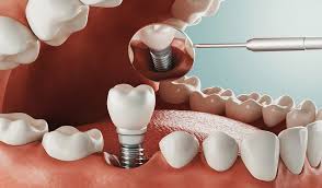 Best Dental Implant Clinic in Kolkata